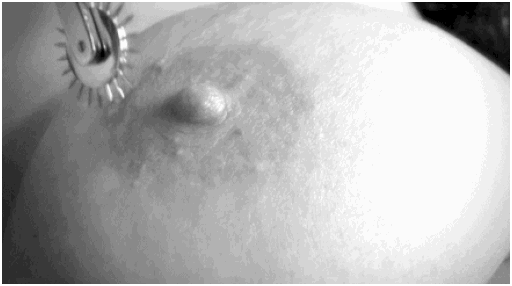 wartenberg pinwheel on a nipple animation